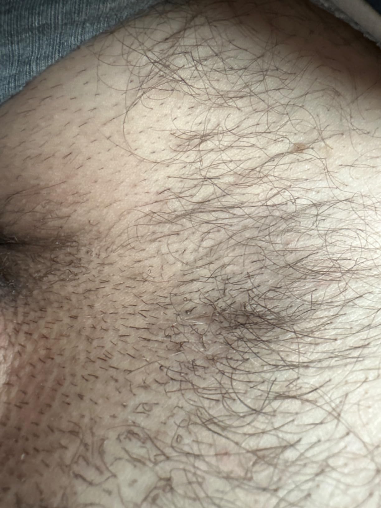 Braun Smart IPL, Skin iExpert Pro 7, VOGUE's Best Hair Removal Device, IPL Hair Removal for Women and Men, Permanent Laser Hair Reduction At-Home, World's 1st Smart App, 3 Heads, IPL7243 customer photo 2