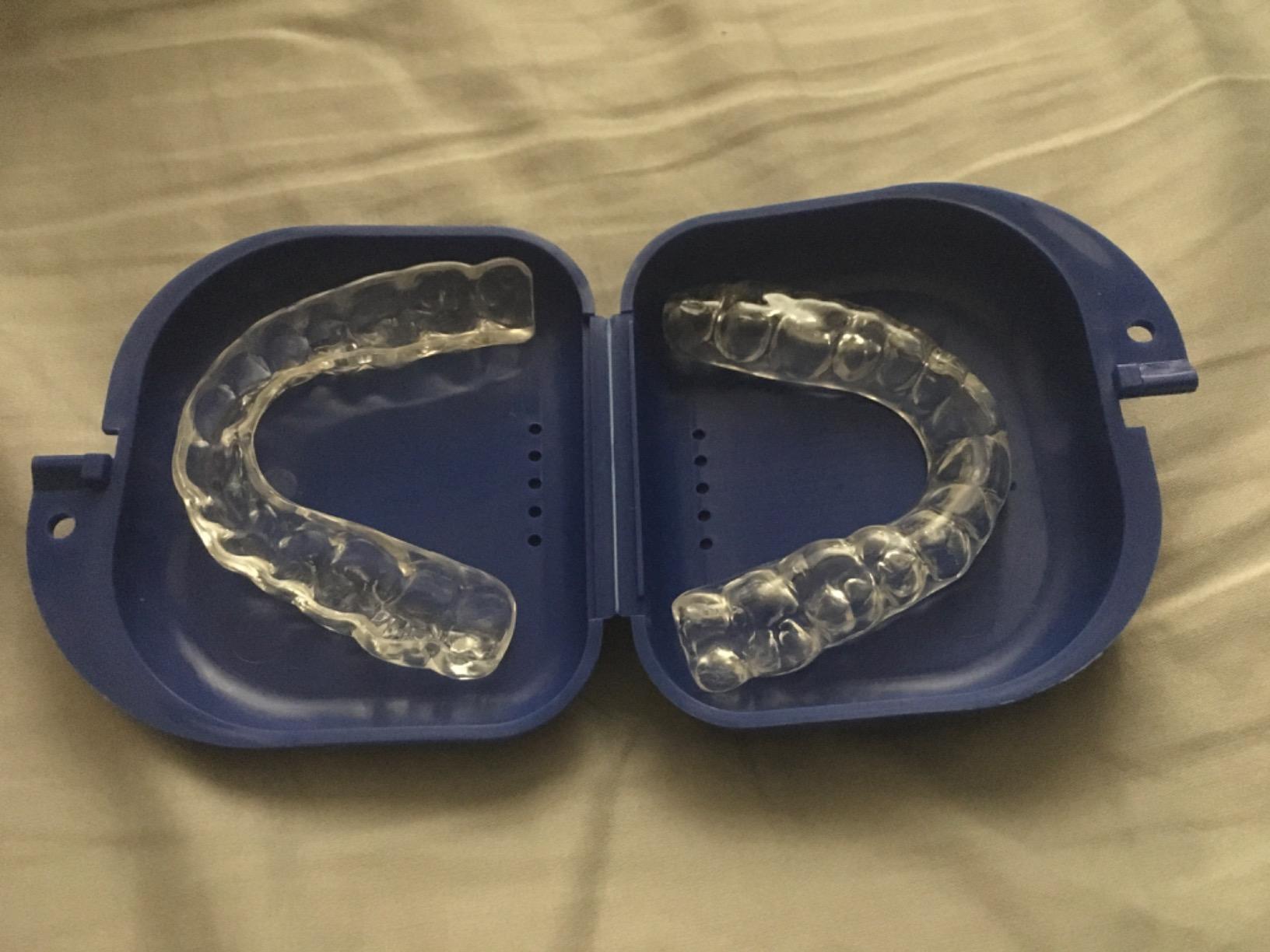 enCore Custom Soft Mouth Guard for Grinding & Clenching Teeth at Night | At-Home DIY Dental Impression Kit | Single Guard Fabricated for Perfect Fit & Lasting Protection | For Mild Bruxism customer photo 1