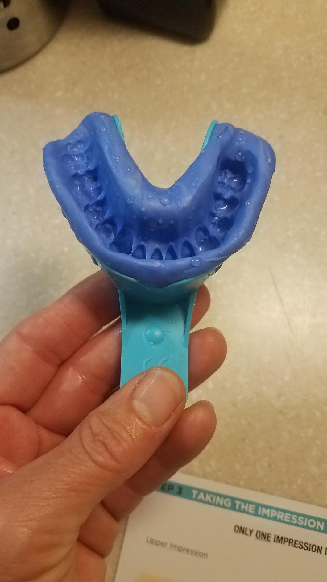 enCore Custom Soft Mouth Guard for Grinding & Clenching Teeth at Night | At-Home DIY Dental Impression Kit | Single Guard Fabricated for Perfect Fit & Lasting Protection | For Mild Bruxism customer photo 2