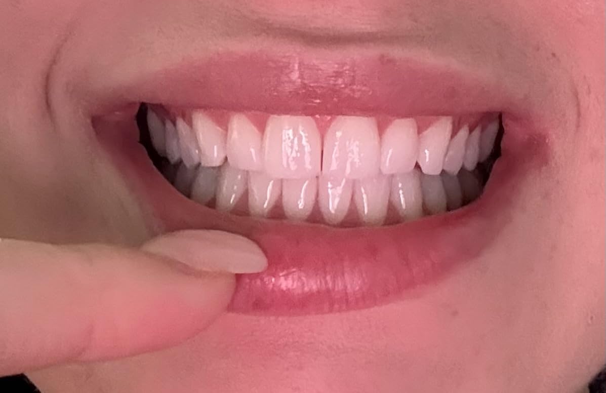 SmileDirectClub Teeth Whitening Kit with LED Light - 4 Pack Gel Pens - Professional Strength Hydrogen Peroxide customer photo 2