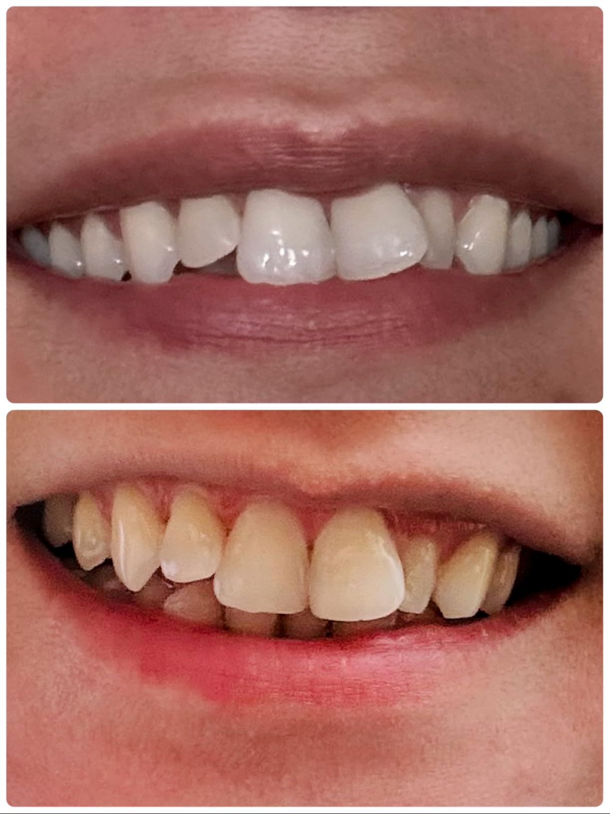 Pdoo Teeth Whitening Kit with LED Light for Sensitive Teeth, Fast Results for Brightening at Home, Teeth Whitening Gel Helps Remove All Kinds of Stains customer photo 1