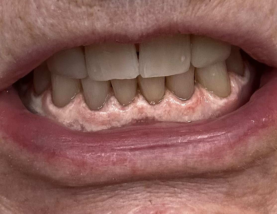 Auraglow Plug-in LED Teeth Whitening Kit - Wired Light Device - 35% Carbamide Peroxide Gel - 12 Treatments - at-Home Tooth Whitening System - Enamel-Safe at-Home Whitening for Coffee & Tea Stains customer photo 1