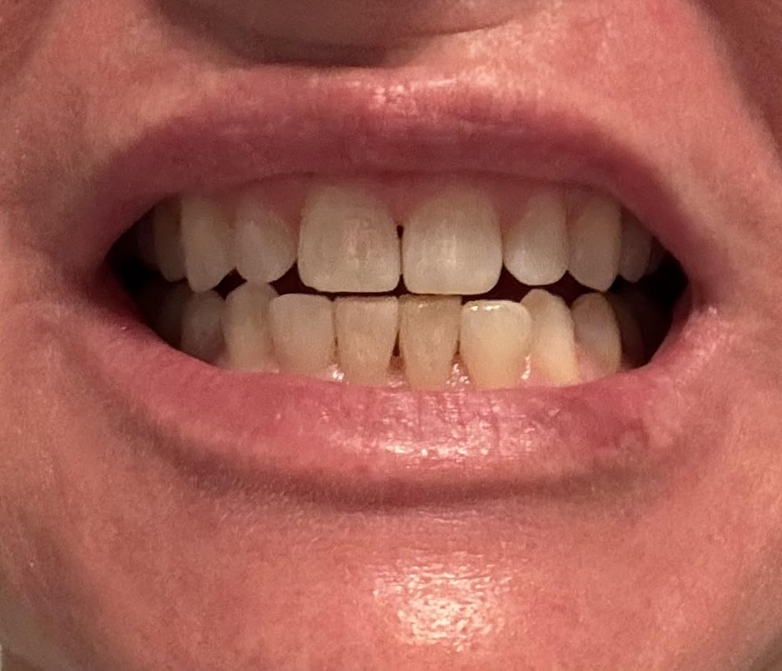 Auraglow Plug-in LED Teeth Whitening Kit - Wired Light Device - 35% Carbamide Peroxide Gel - 12 Treatments - at-Home Tooth Whitening System - Enamel-Safe at-Home Whitening for Coffee & Tea Stains customer photo 2